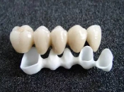 維港口腔專家牙醫詳談固定假牙嘅特點