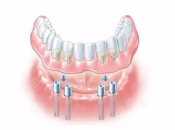 深圳All-on-4半口植牙嘅優點係咩咧？深圳半口植牙要幾錢？