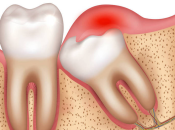 智慧齒點解會發炎咧？深圳剝智慧齒幾錢？