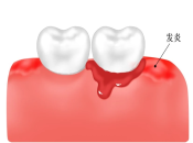 牙齦出血儘快上深圳睇牙，避免牙周病病情加重