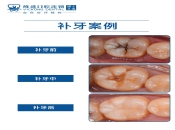 深圳補牙，3m z350和3m z250有哪些區別呢？
