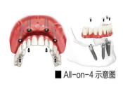 大陸種植牙推介，全口牙缺失選All-on-4和All-on-6植牙邊個更好？