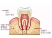 返大陸種牙，點解種牙前醫生要檢查牙槽骨情況？