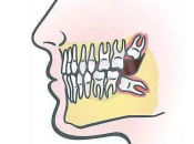 點解智慧齒會阻生？深圳邊度剝牙好？深圳剝智慧齒幾錢？