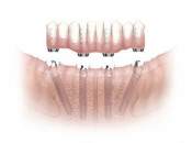 大陸ALL-ON-4種植技術點樣？附大陸全口植牙價目表2023