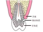 牙齒靠近牙齦的地方缺了一塊是什麽原因？