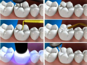 深圳補牙推介，補牙嘅樹脂材料可以使用多長時間？ 