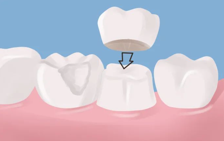 深圳杜牙根後幾時可以做牙冠？點解牙醫都建議做牙冠咧？
