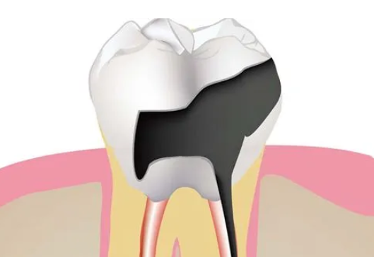 深圳蛀牙補牙介紹：補牙之後仲牙痛需如何處理?