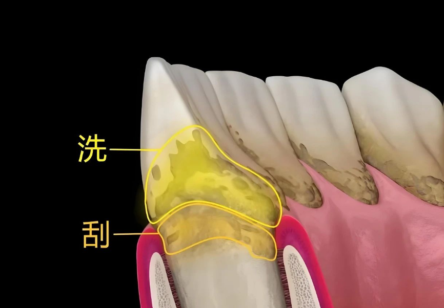 深圳牙周治療