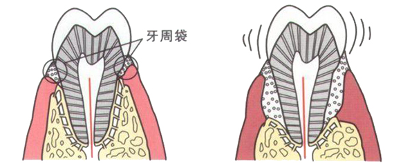 深圳牙周治療介紹