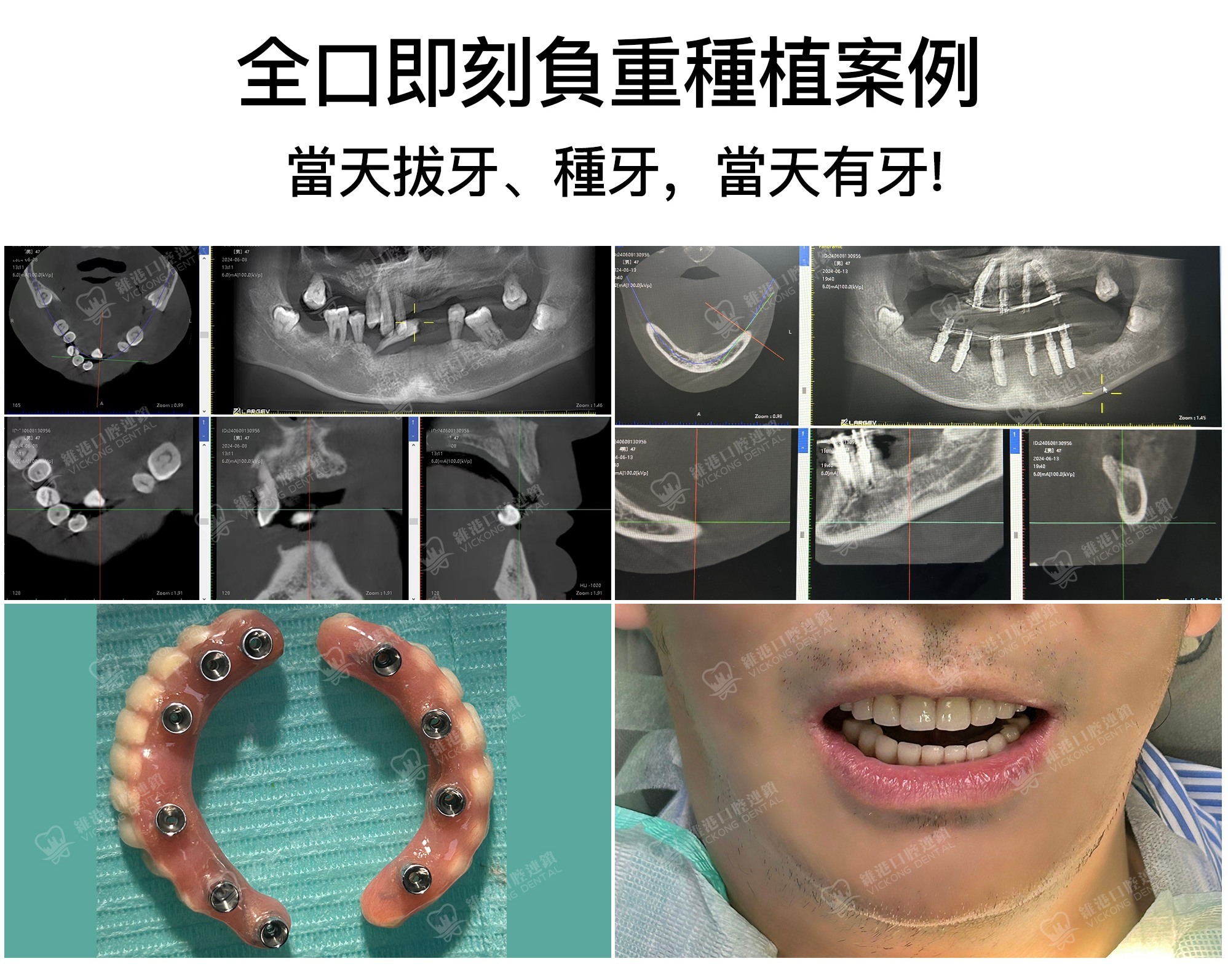 深圳維港口腔微創全口植牙