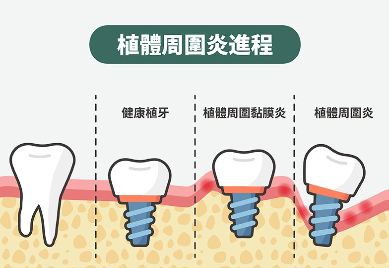 深圳種牙失敗