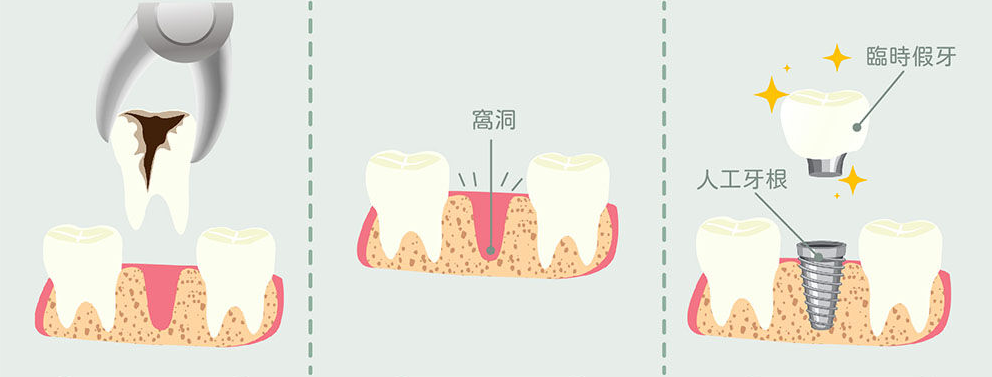 深圳種植牙