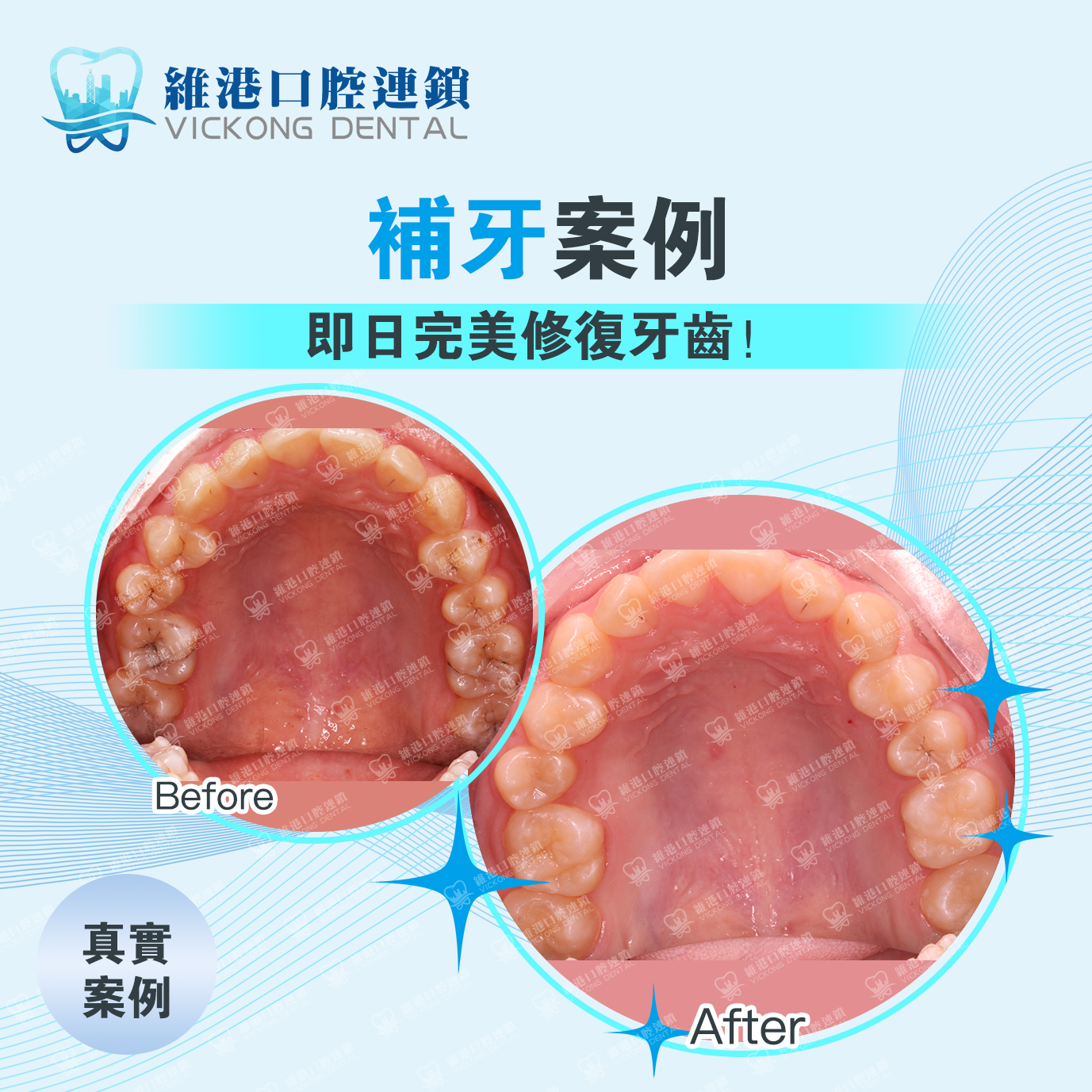 維港口腔補牙效果