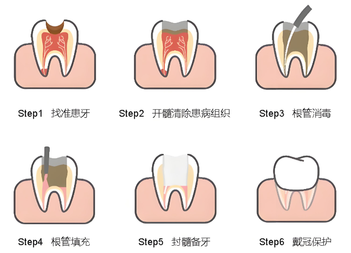 深圳根管治療