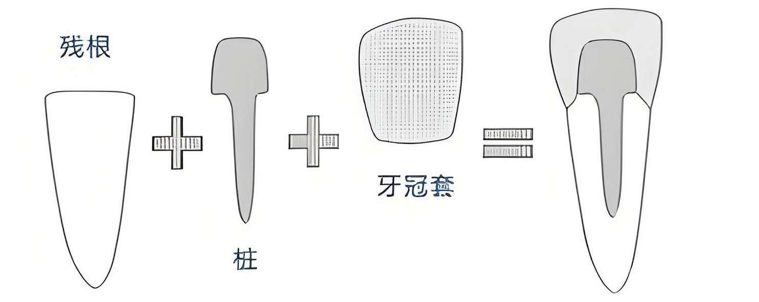 深圳杜牙根牙套