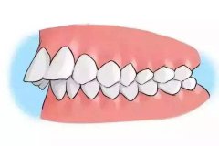 骨性齙牙和牙性齙牙有什麼區別呢？怎樣預防齙牙呢？