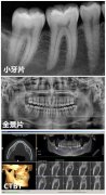 【深圳拔牙科普】拔牙前一定要拍片嗎？拍片有害嗎？