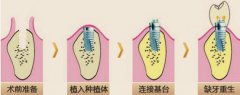 【深圳種植牙】種植牙術後需要多久才可以痊癒呢？