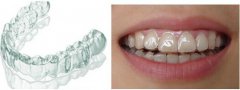 深圳箍牙科普-隱形牙套同鋼牙箍牙效果一樣嗎？