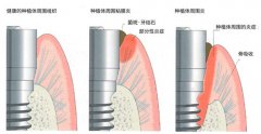 深圳種植牙科普-種植體周圍炎是怎麼一回事呢 ！