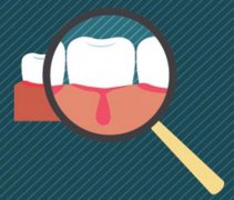 深圳牙周治療-牙齦炎有哪些表現呢？