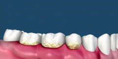 什麼導致牙床腫痛呢？