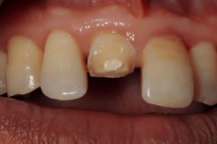 門牙斷牙修復案例