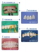 維港口腔連鎖品牌瓷牙貼面的美學技術優勢