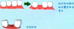 深圳種植牙-牙齒缺失後不鑲牙對健康有影響嗎