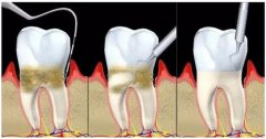深圳牙周治療科普-侵襲性牙周炎有哪些表現？