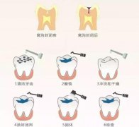 深圳補牙—補牙為何越早越好