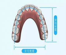 牙列擁擠的錯頜畸形都需要拔牙矯治嗎？