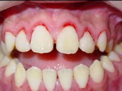 牙周炎為什麼常常導致口臭？