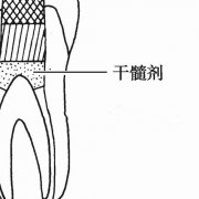 幹髓療法是什麼呢？