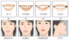 深圳箍牙科普-牙頜畸形的不良影響