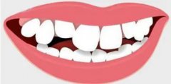 牙頜畸形的表現有哪些呢？
