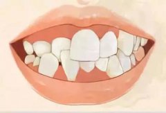 造成牙頜畸形的遺傳和先天性因素有什麼呢？