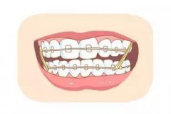 牙頷畸形矯正過程中應注意哪些問題？