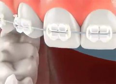 換牙期矯治的適應證及特點是什麼？