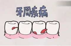 牙周病是怎樣引起的？