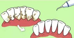 引起牙周病的局部因素有哪些呢？