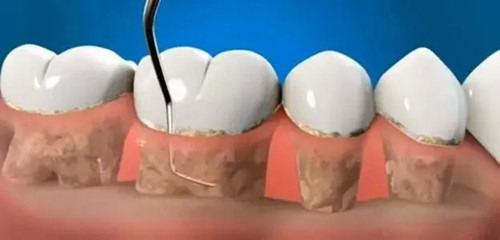 深圳牙周治療