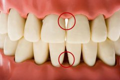怎樣進行牙齦按摩？有哪些防治作用？