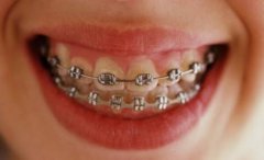 為什麼矯治錯頜畸形時要拔牙？